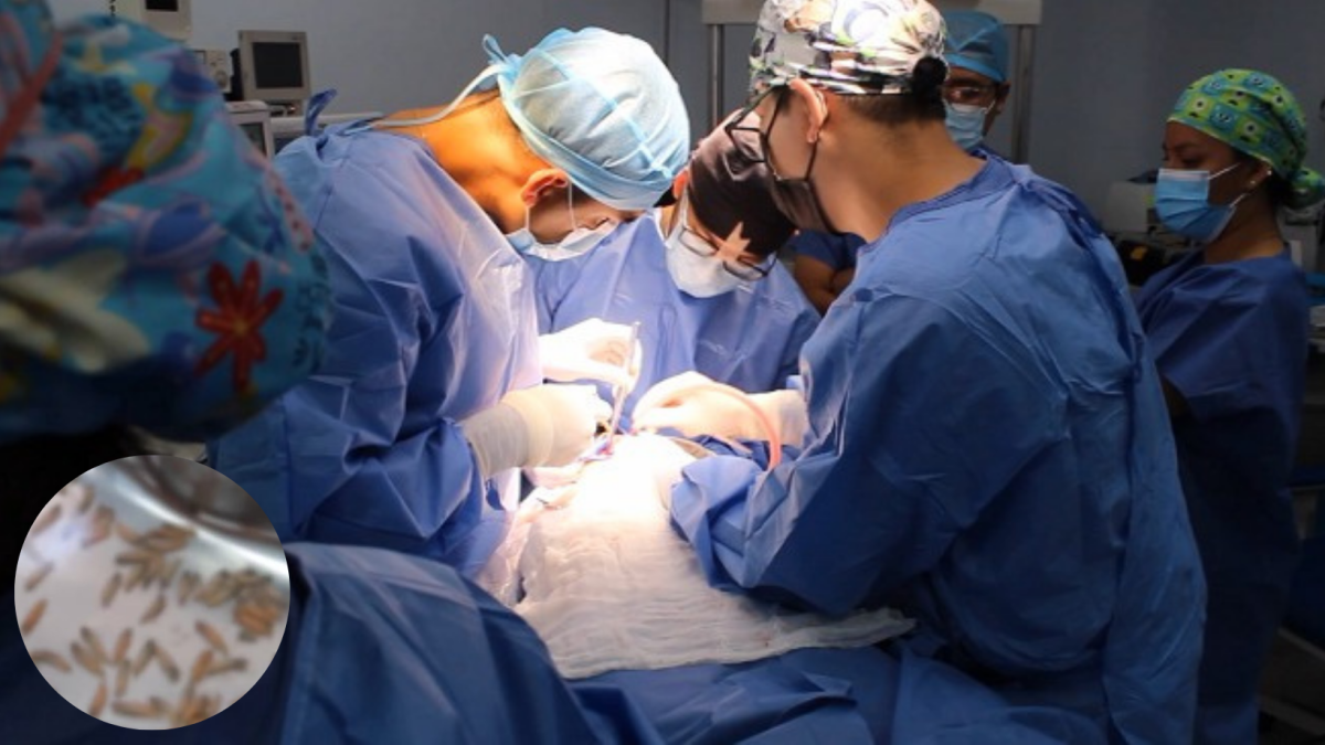 Miíase oral: médicos retiram mais de 100 larvas alojadas na boca de uma mulher, no Peru; entenda - Rádio Itatiaia