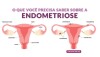 Endometriose é uma doença inflamatória, caracterizada pela presença de endométrio fora da cavidade uterina