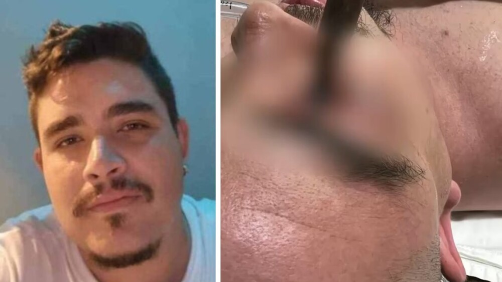 Foto mostra Osmar Júnior, homem de 31 anos que teve o olho perfurado pr um taco de sinuca