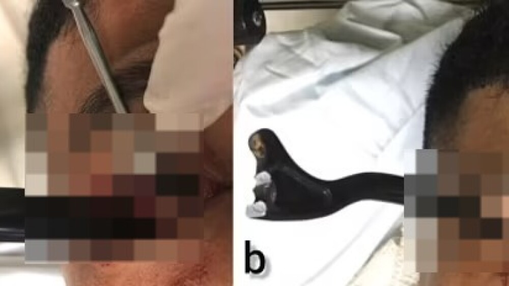 Alavanca de freio de moto atinge olho de jovem na Malásia; por pouco, ele não perdeu a visão - Rádio Itatiaia